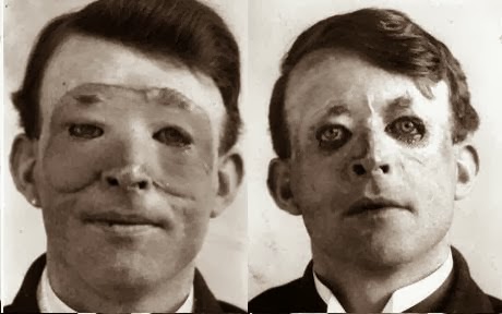 Η πρώτη πλαστική χειρουργική επέμβαση το 1917